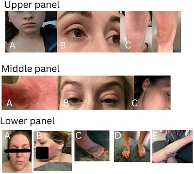 Comprehensive clinical phenotype, genotype and therapy in Yao syndrome